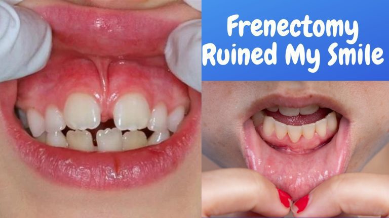 Unexpected Consequences: How Frenectomy Ruined My Smile?